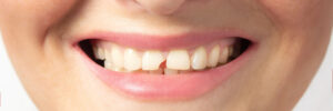 prairie village broken teeth