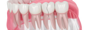 prairie village cracked teeth