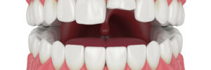 prairie village chipped tooth