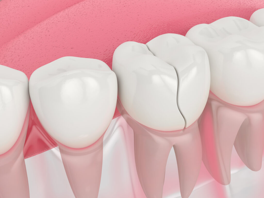 Treating Chipped And Fractured Teeth | Prairie Village, KS