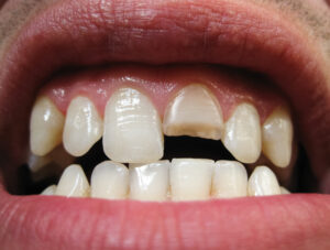 prairie village broken tooth