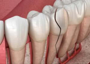 prairie village cracked tooth