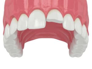 prairie village emergency chipped teeth