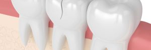 prairie village cracked teeth