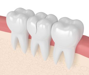 prairie village cracked teeth